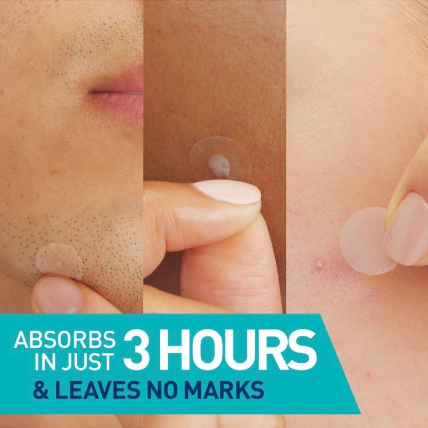 CeraVe Acne Control Patches - 22ct